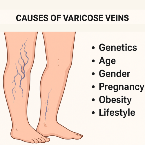 causes of varicose veins