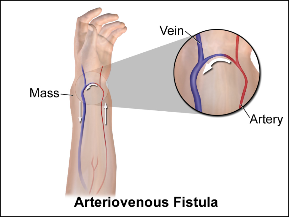Arteriovenous Fistula 
